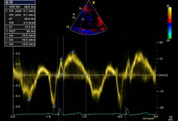 2-D Echocardiography